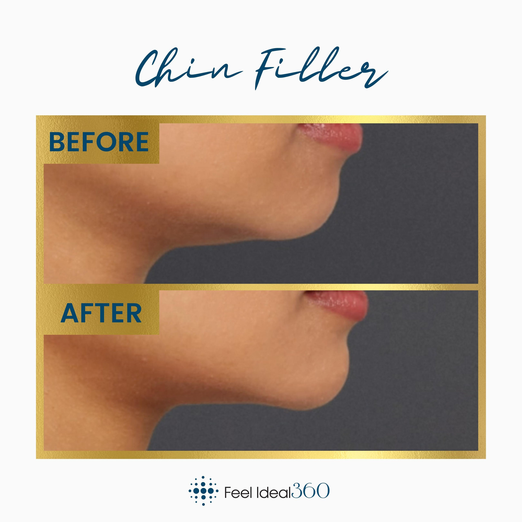 Chin Filler Before And After Feel Ideal Med Spa Southlake TX