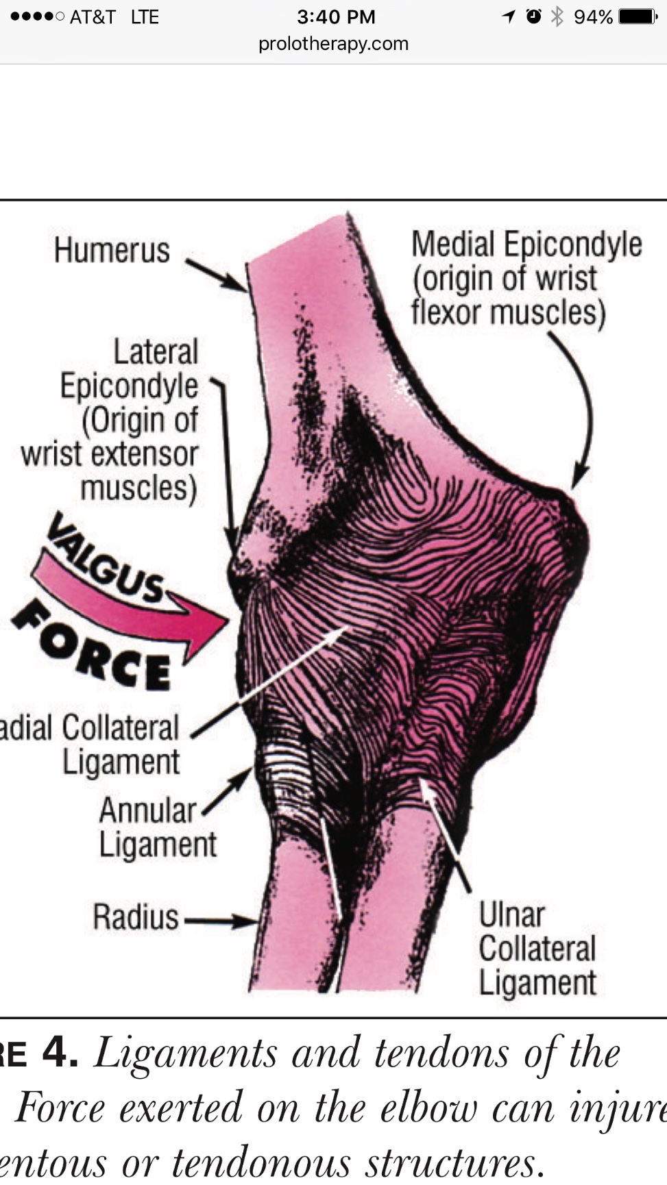 Prolotherapy vs Cortisone Injections The Orthobiologic Clinic