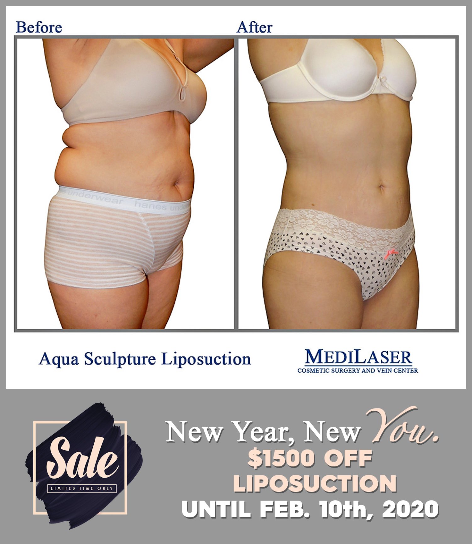 Liposuction Before And After Medilaser Surgery And Vein Center 