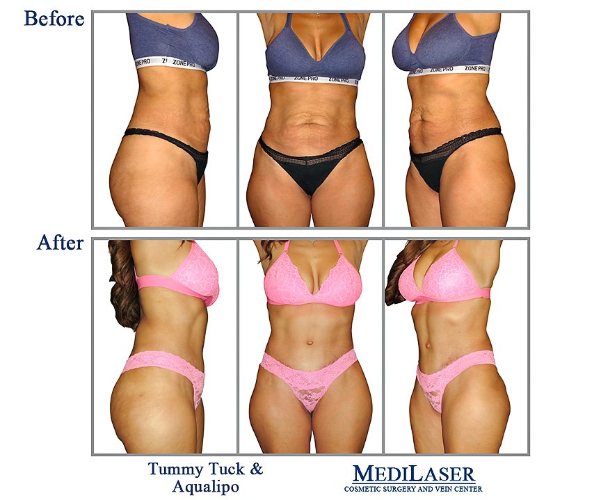 A Tummy Tuck Can Change Your Life! - Medilaser Surgery and Vein Center