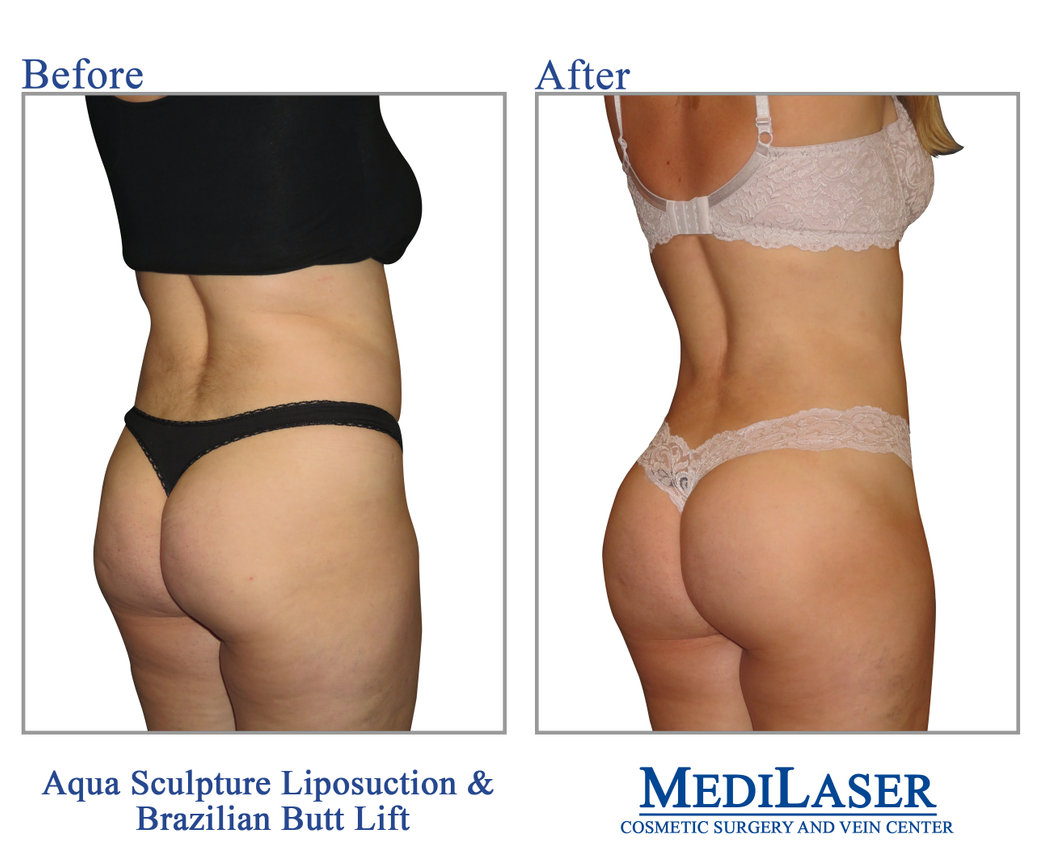 Best Brazilian Butt Lift Medilaser Cosmetic Surgery Frisco Texas -  Medilaser Surgery and Vein Center