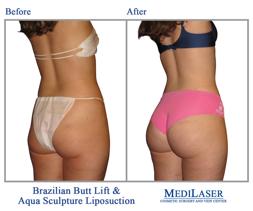 Brazilian Butt Lift (BBL) Surgery