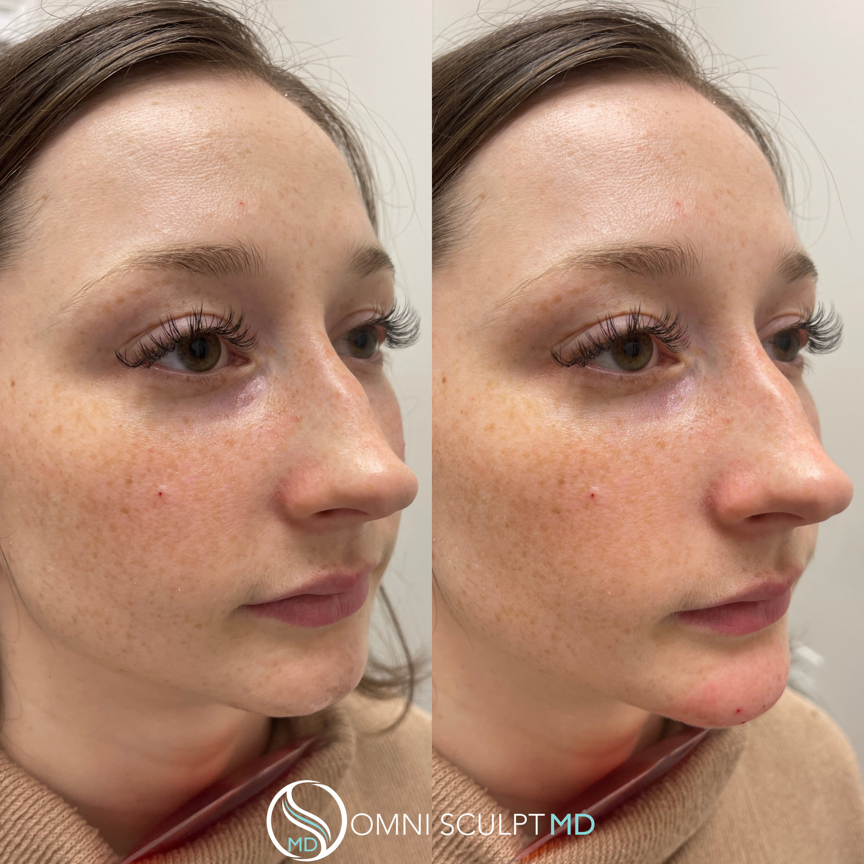 Chin and Jawline Filler in Dallas, TX OMNI SCULPT MD