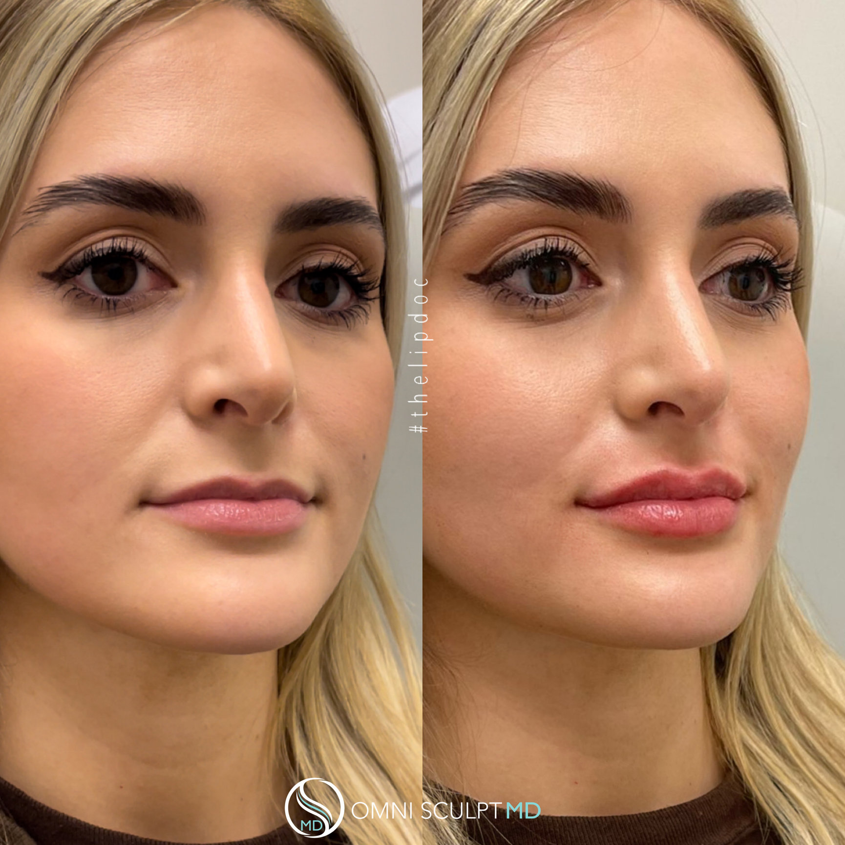 Lip Injections Before And Afters Omni Sculpt Md Dallas Texas