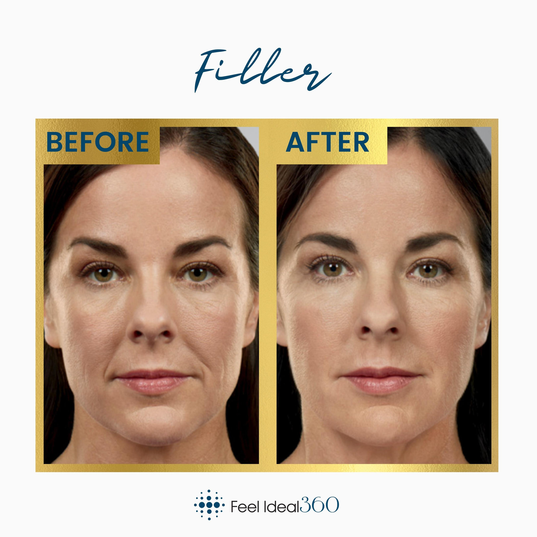 Facial Filler Before And After Southlake Texas Feel Ideal 360 Med Spa Southlake Tx 9174