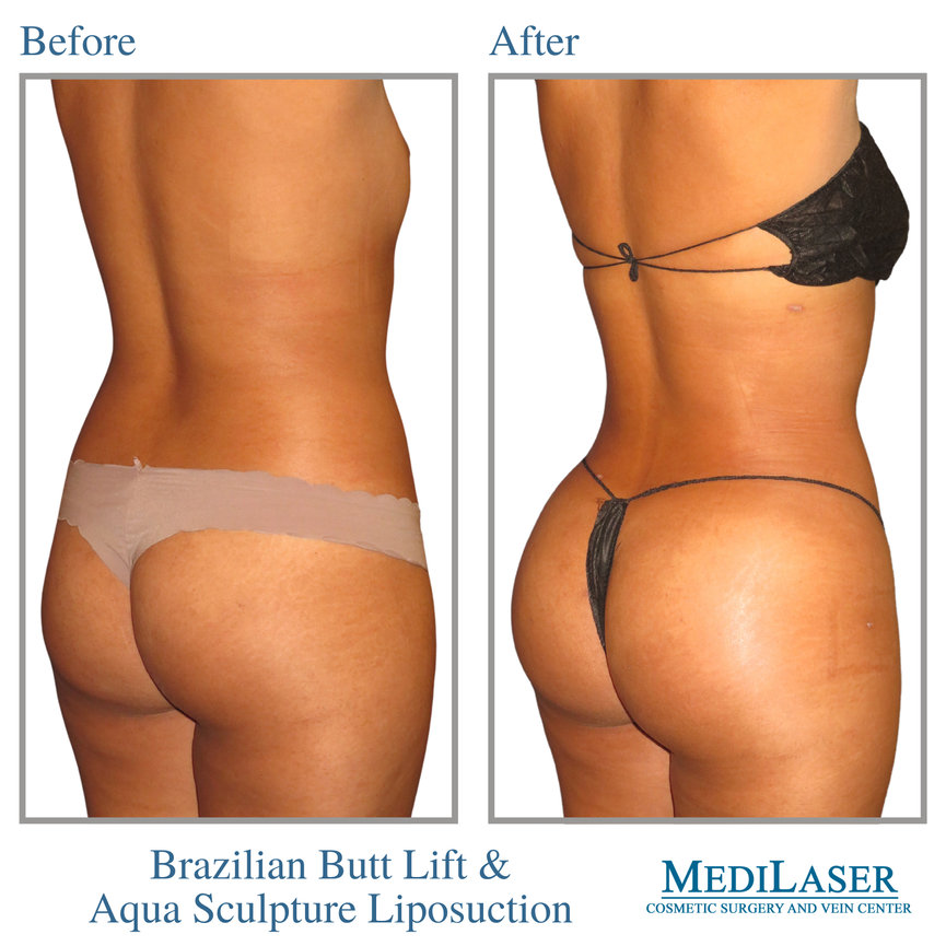 Brazilian Butt Lift Before and After - Medilaser Surgery and Vein Center