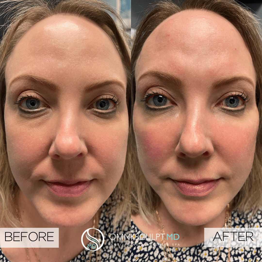 Facial Filler Before & After Gallery OMNI SCULPT MD